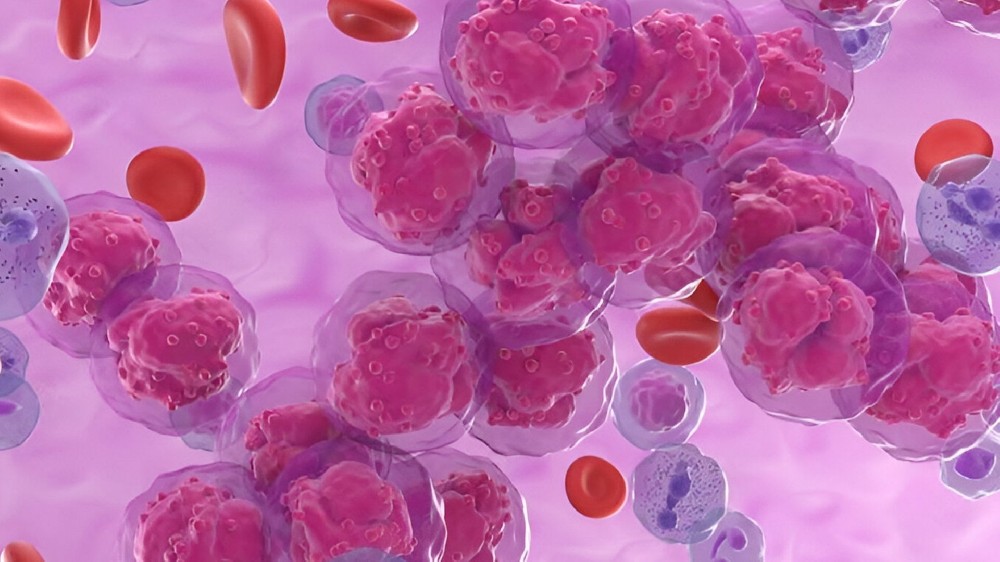 急性淋巴細胞白血病 (ALL)