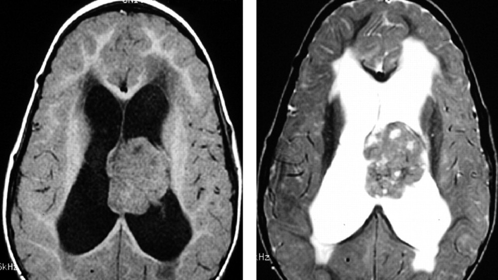 非典型鱗狀横纹肌瘤 (ATRT)