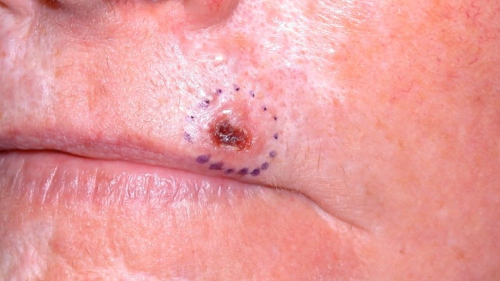 基底細胞皮膚癌 (Basal Cell Carcinoma) 1 基底細胞皮膚癌 (Basal Cell Carcinoma)