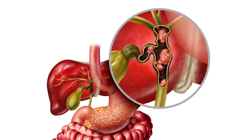 膽管癌(膽管癌)1 膽管癌(膽管癌)