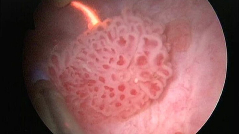 膀胱癌(膀胱上皮癌) 1 膀胱癌(膀胱上皮癌)