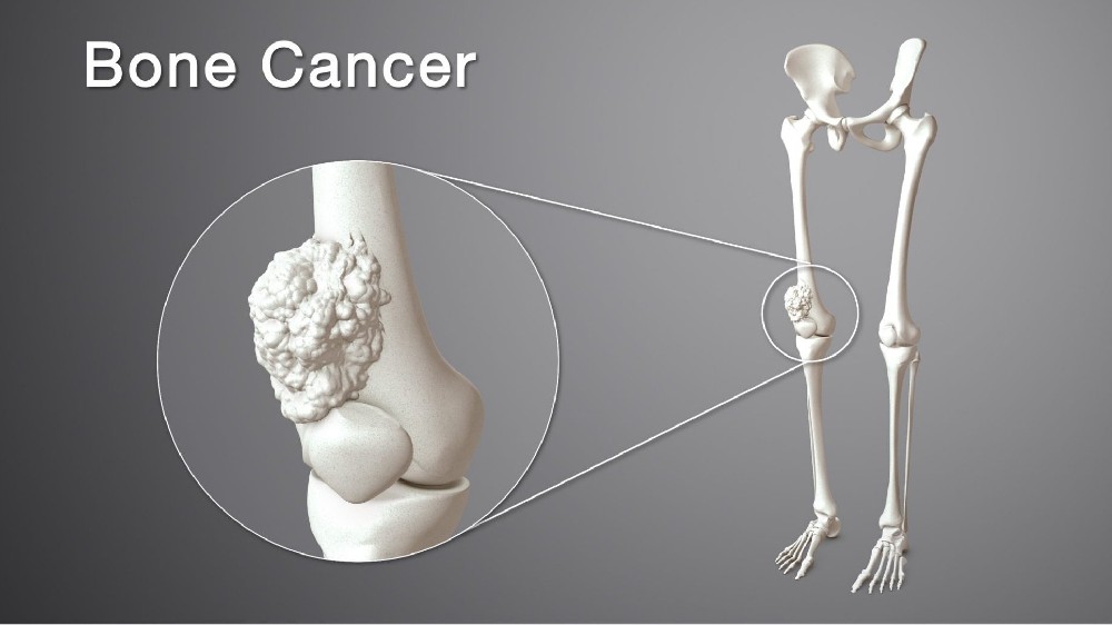 骨癌（骨肉瘤）