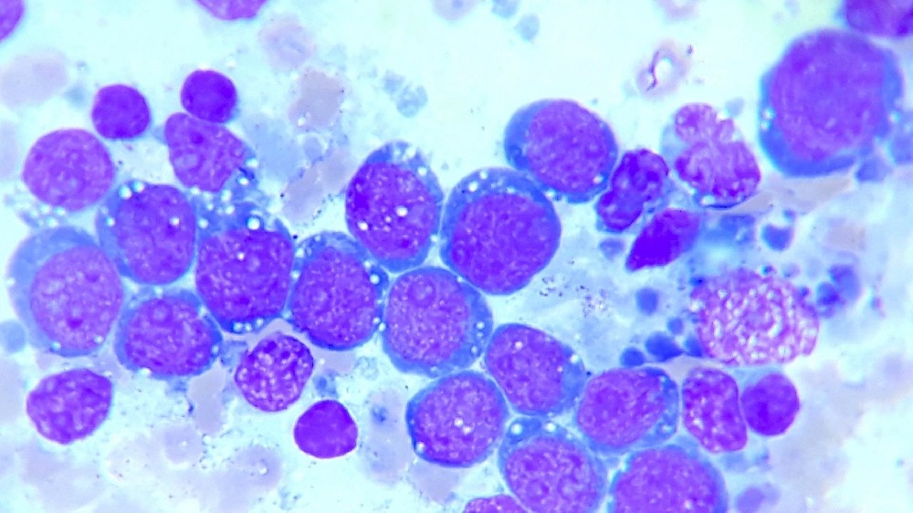 伯基特淋巴瘤(B細胞非霍奇金淋巴瘤)1 伯基特淋巴瘤(B細胞非霍奇金淋巴瘤)