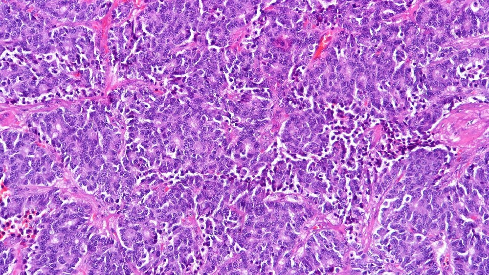 類癌(神經內分泌腫瘤)1 類癌(神經內分泌腫瘤)