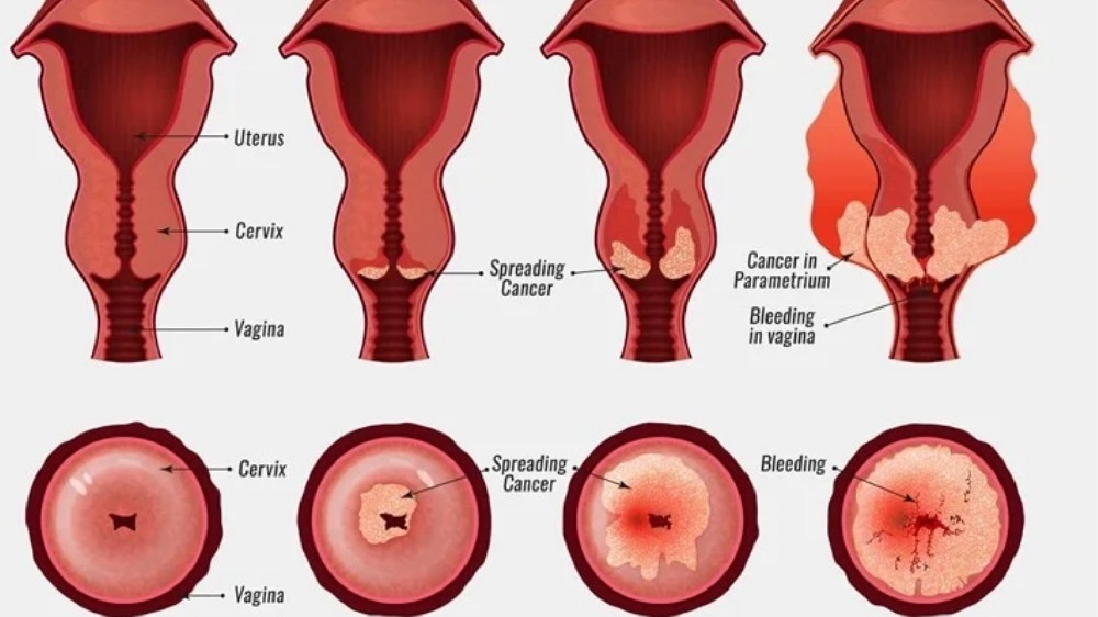 子宮頸癌(子宮頸癌) 1 子宮頸癌 (Cervical Carcinoma)