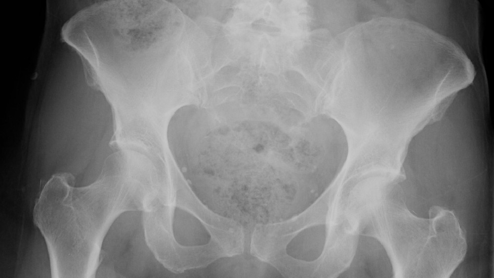 脊索瘤(脊索骨腫瘤)1 脊索瘤(脊索骨腫瘤)