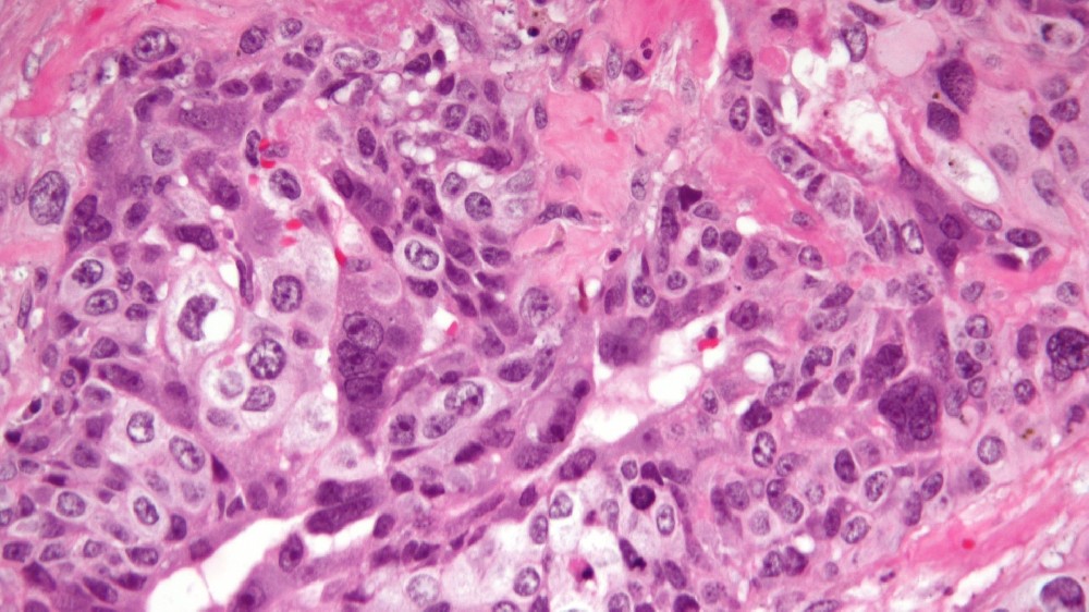 絨毛膜癌(妊娠滋養腫瘤)1 絨毛膜癌(妊娠滋養腫瘤)