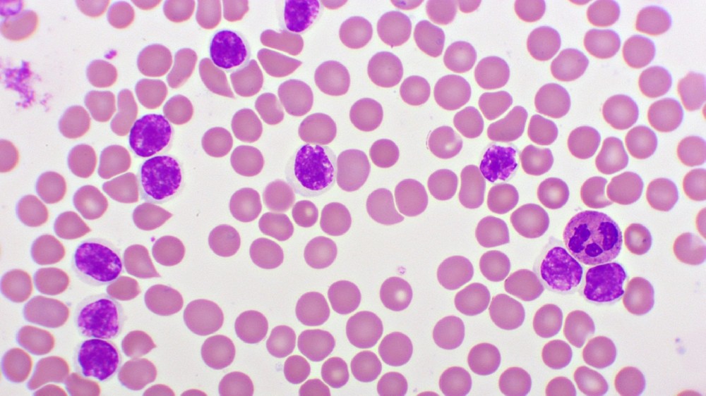 慢性淋巴細胞白血病 (CLL) 1 慢性淋巴細胞白血病 (CLL)