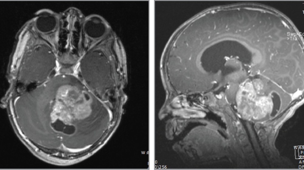 彌漫性內在性腦脊髓膠質瘤 (DIPG) 1 彌漫性內在性腦脊髓膠質瘤 (DIPG)