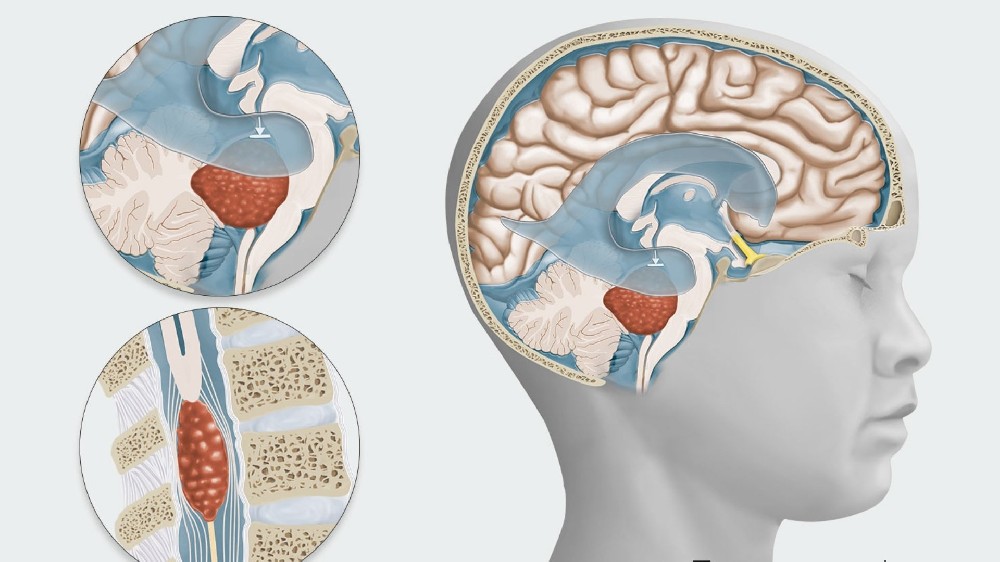 腎上腺瘤 (腦上腺瘤) 1 腎上腺瘤 (腦上腺瘤)