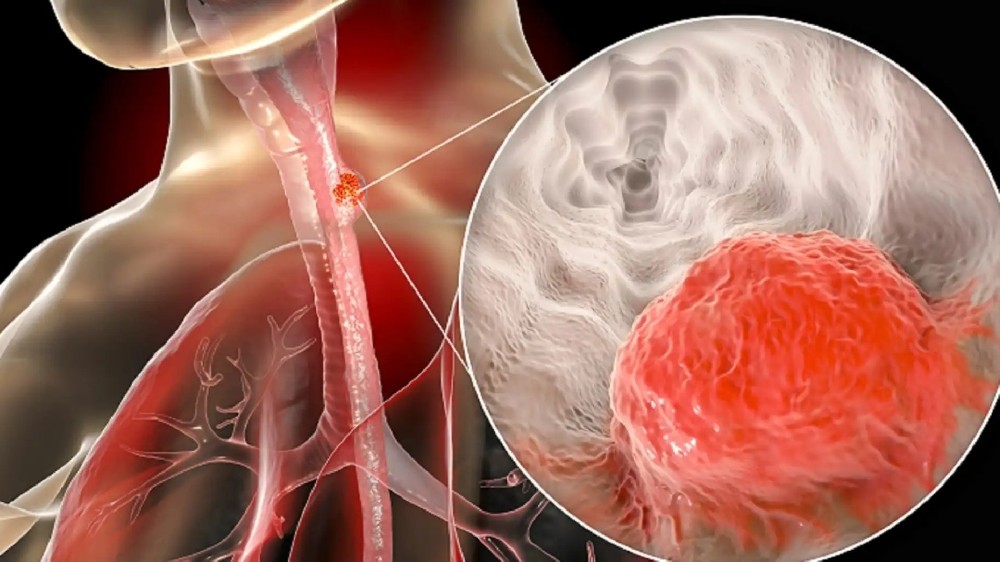 食道癌(食道癌)1 食道癌(食道癌)