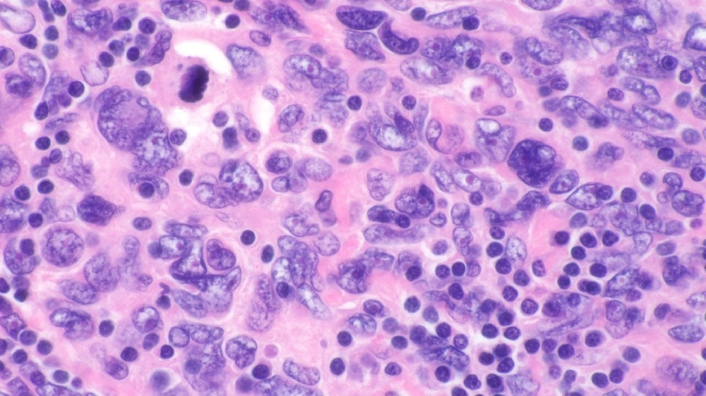 卵泡樹突細胞肉瘤 (FDCS)