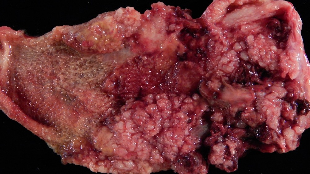 膽囊癌(膽囊癌) 1 膽囊癌 (Gallbladder Carcinoma)