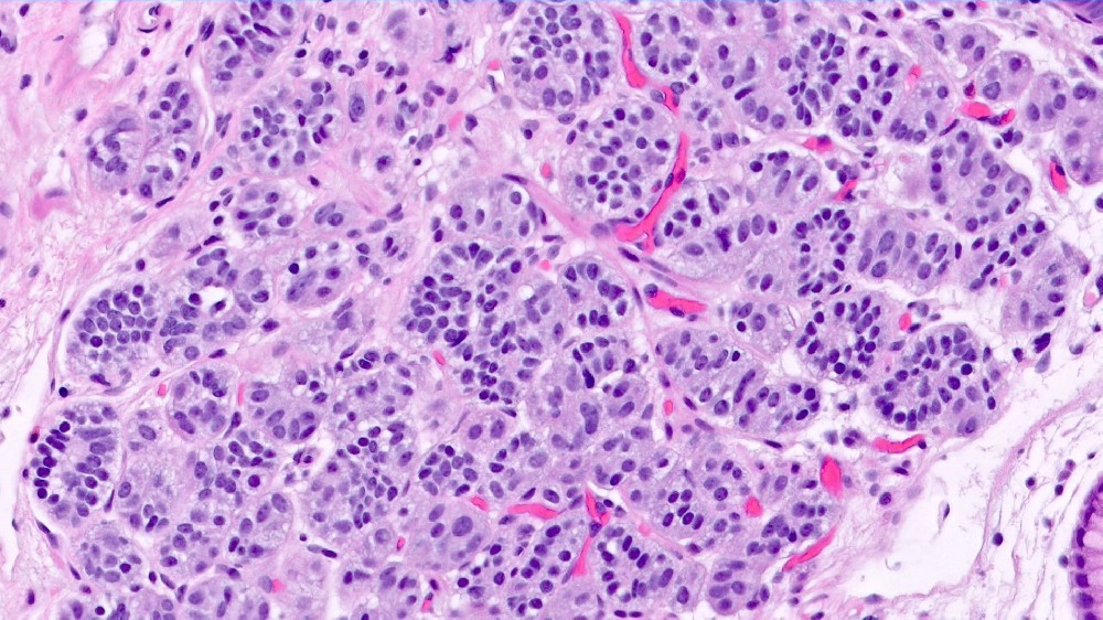 胃腸神經內分泌腫瘤(類癌腫瘤)1 胃腸道神經內分泌腫瘤 (類癌)