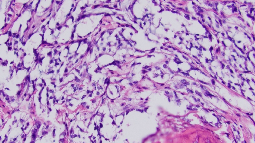 胃腸道間質腫瘤 (GIST)