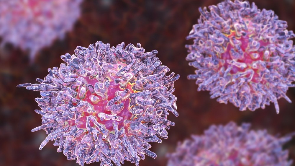 毛細胞白血病 (HCL) 1 毛細胞白血病 (HCL)