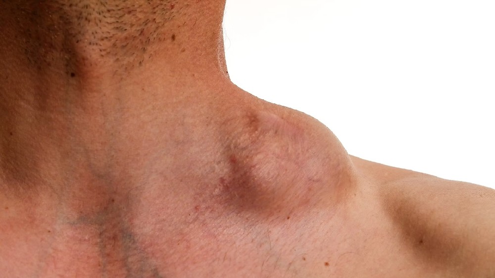 霍奇金淋巴瘤(霍奇金病)1 霍奇金淋巴瘤(霍奇金病)