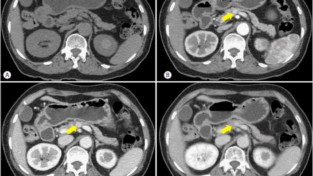 胰細胞腫瘤(胰臟神經內分泌腫瘤)1 胰腺神經內分泌腫瘤