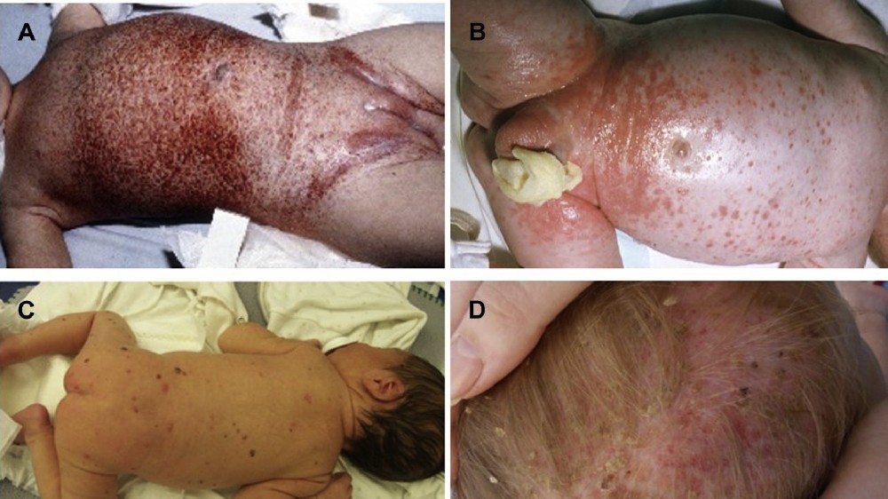 朗格汉斯细胞组织细胞增生症 (LCH) 1 朗格汉斯细胞组织细胞增生症 (LCH)