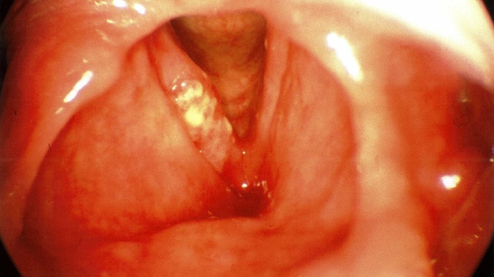 喉癌 (Laryngeal Carcinoma) 1 喉癌 (Laryngeal Carcinoma)