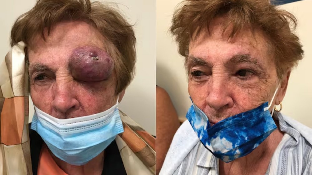 梅爾克細胞癌(梅爾克細胞皮膚癌)1 梅爾克細胞癌(梅爾克細胞皮膚癌)