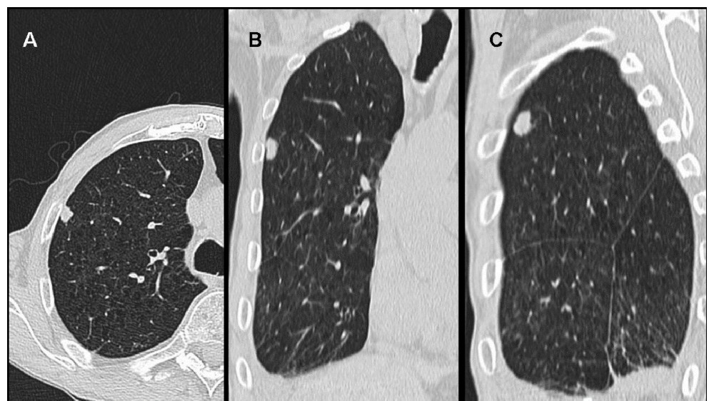 間皮瘤（惡性間皮瘤）