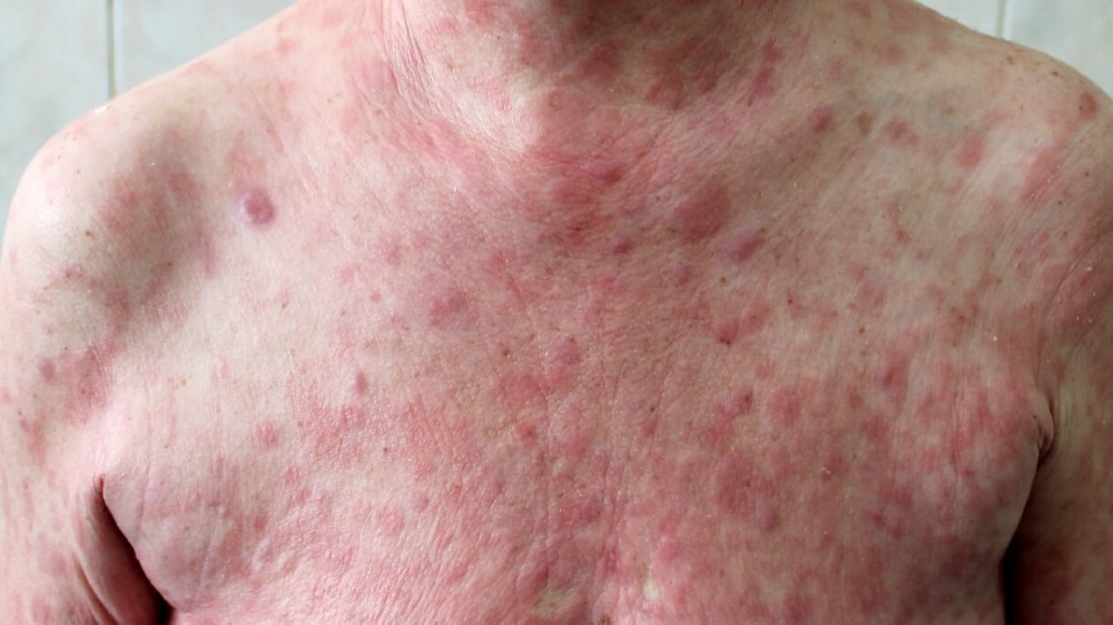 真菌病(皮膚 T 細胞淋巴瘤)1 真菌病(皮膚 T 細胞淋巴瘤)