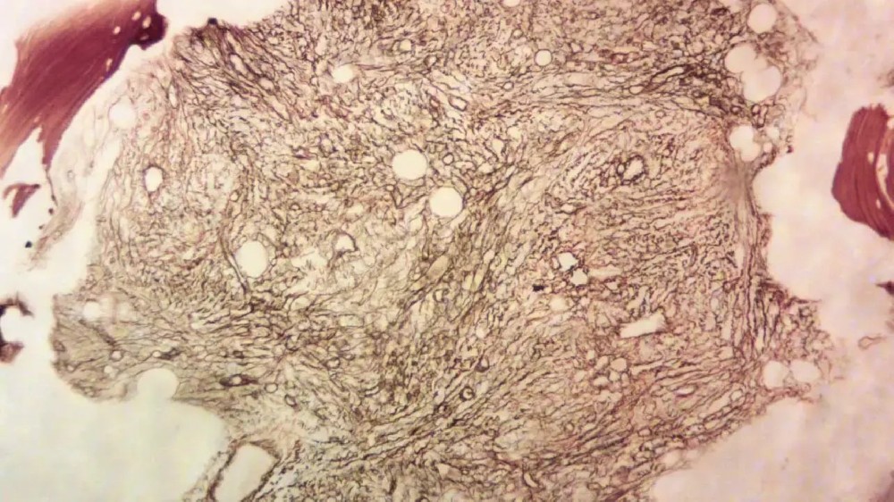 骨髓纖維化(原發性骨髓纖維化)1 骨髓纖維化(原發性骨髓纖維化)