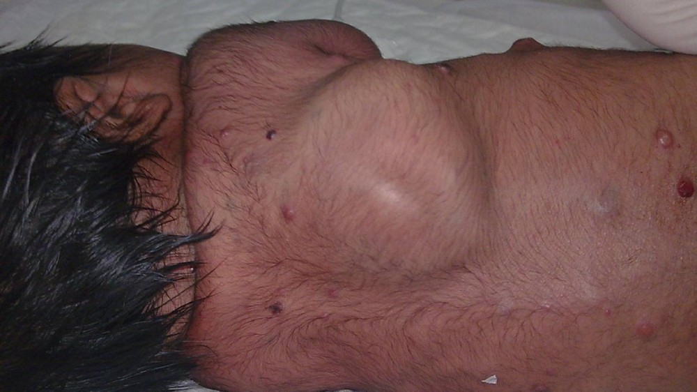 神經母細胞瘤 1 神經母細胞瘤