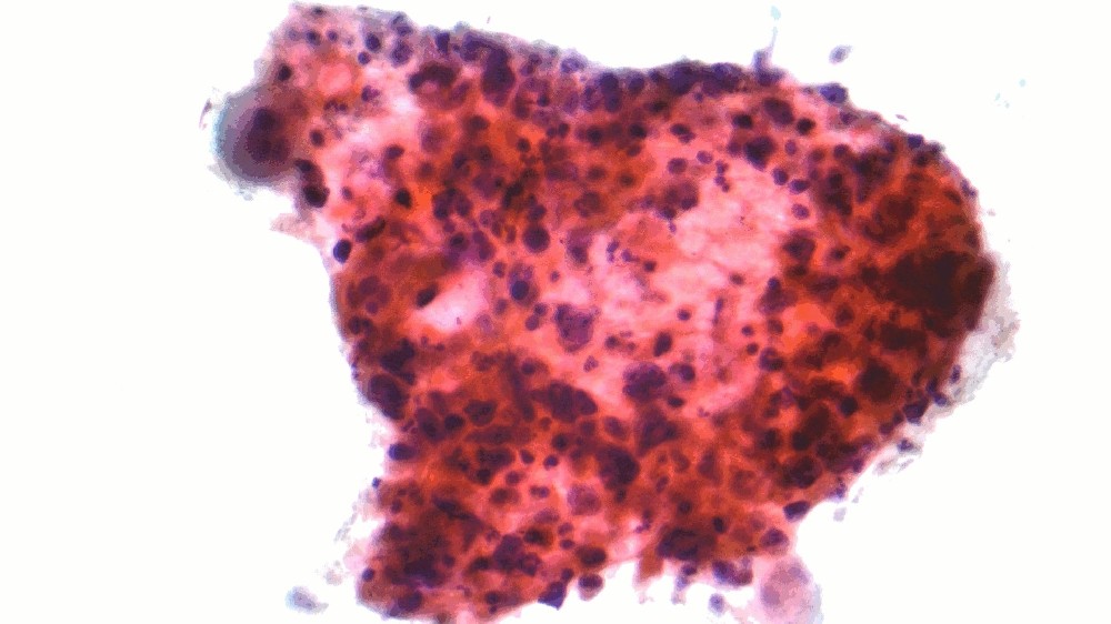 非小細胞肺癌 (NSCLC) 1 非小細胞肺癌 (NSCLC)