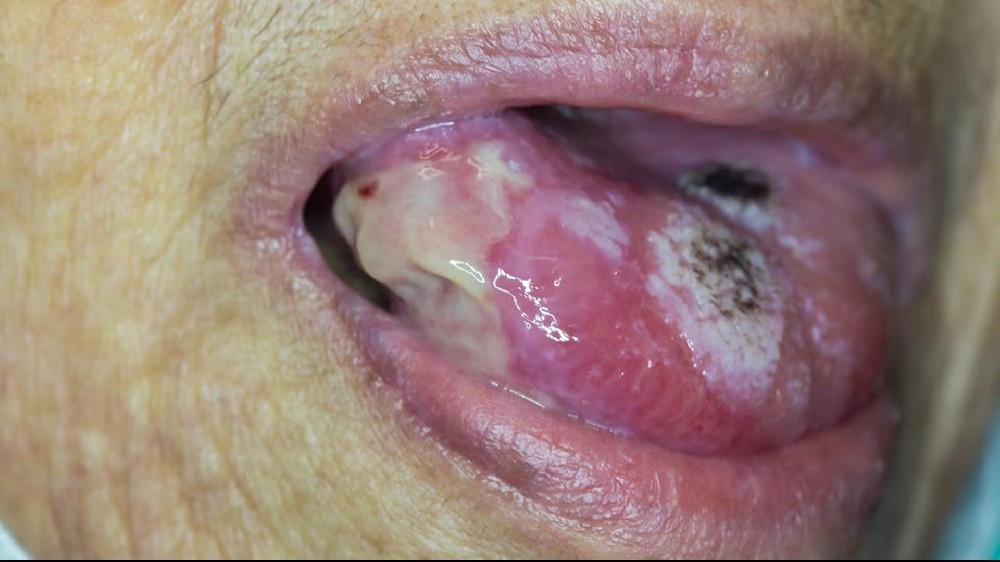 口腔癌(口腔癌) 1 口腔癌(口腔癌)