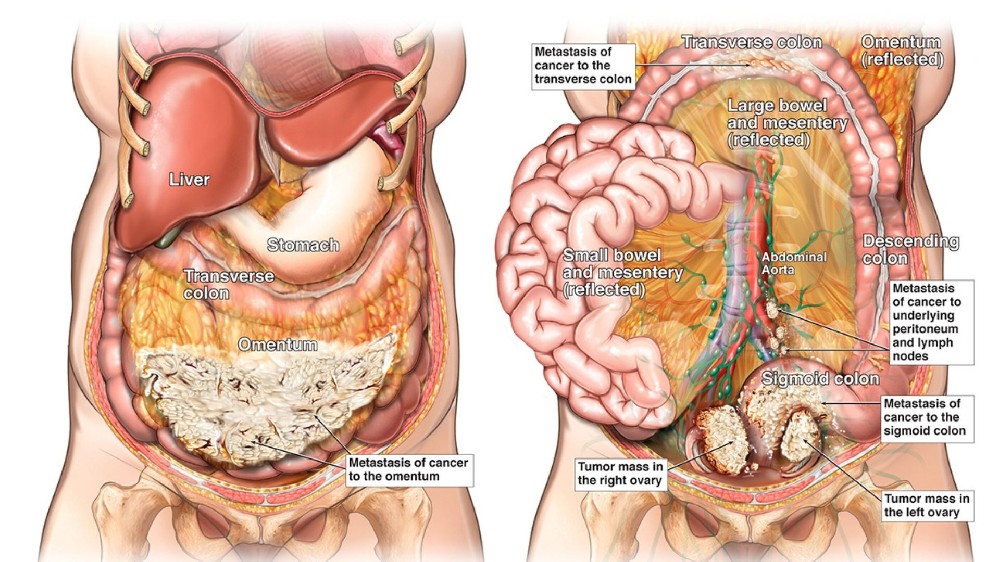 卵巢癌(卵巢癌) 1 卵巢癌(卵巢癌)