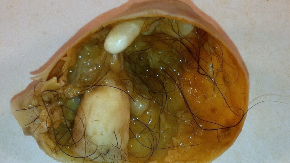 卵巢生殖細胞腫瘤 1 卵巢生殖細胞腫瘤