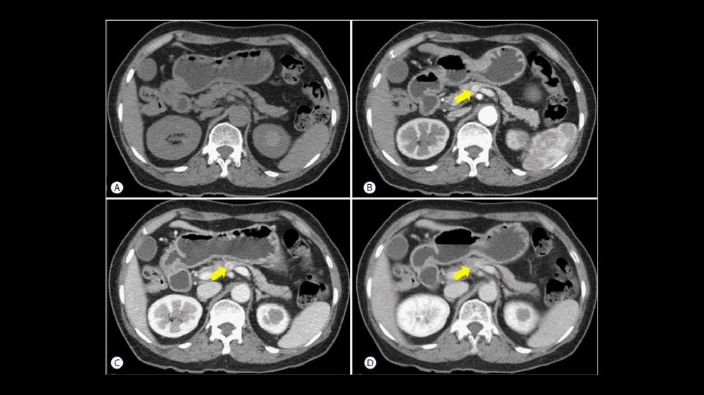 胰臟神經內分泌腫瘤（胰島細胞瘤）