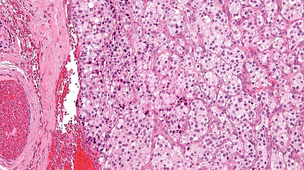 Paraganglioma 1 Paraganglioma