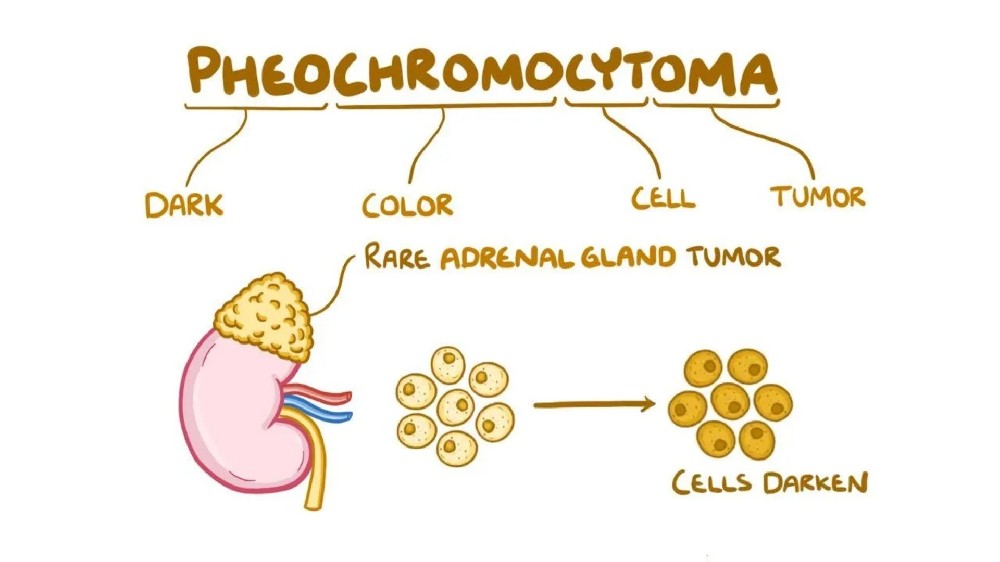 嗜鉻細胞瘤 1 嗜鉻細胞瘤