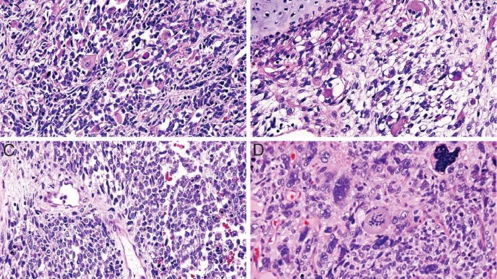 胸膜肺母细胞瘤 (PPB)