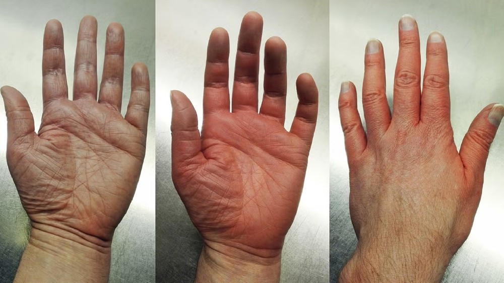 多血球叢生症 (PV)