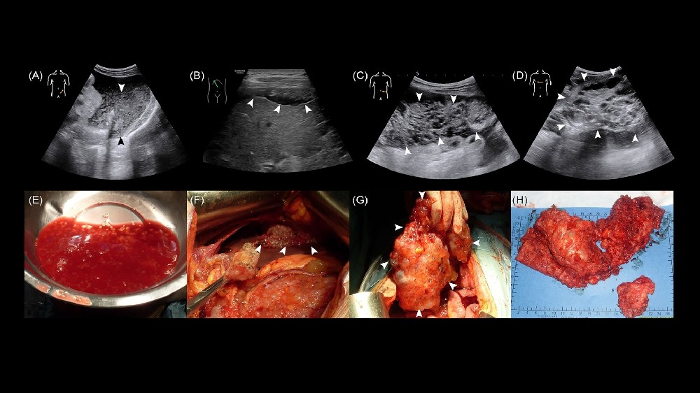 假性腹膜肌瘤 (PMP) 1 假性腹膜肌瘤 (PMP)