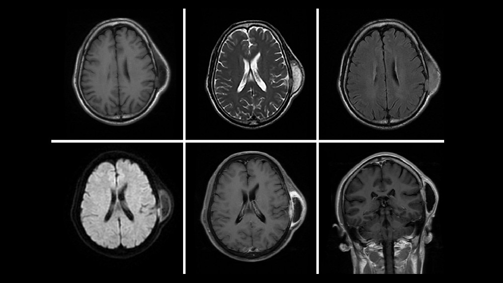横纹肌肉瘤（肌肉软组织肉瘤）