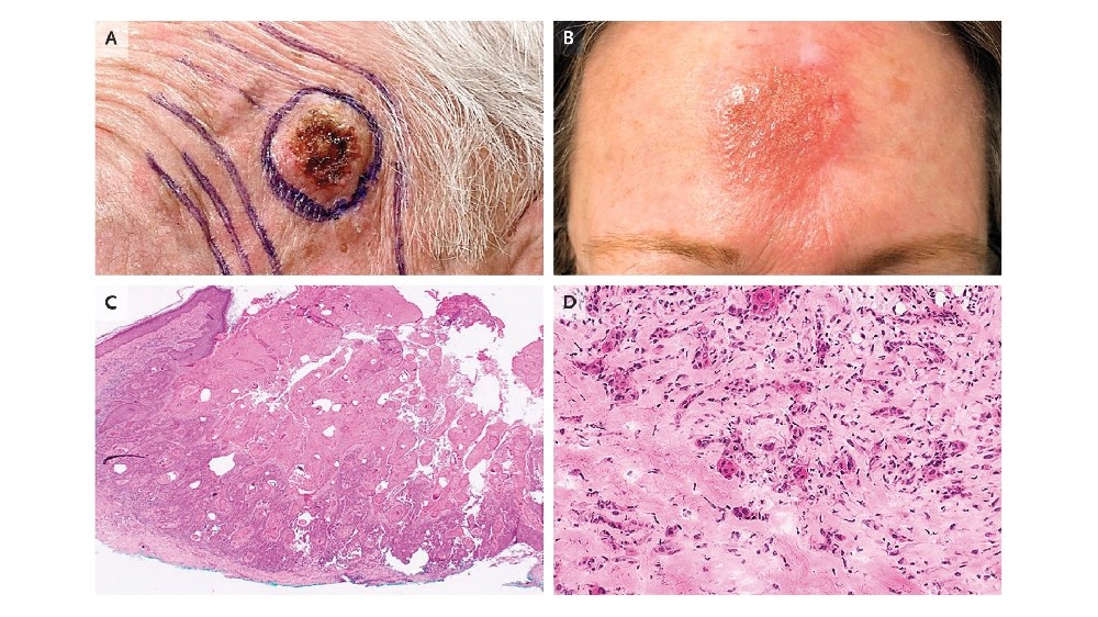 皮膚癌（皮膚癌）