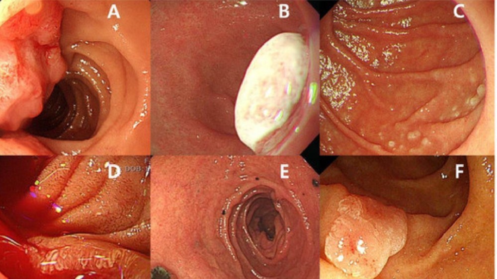 小腸癌(小腸癌)1 小腸癌(小腸癌)