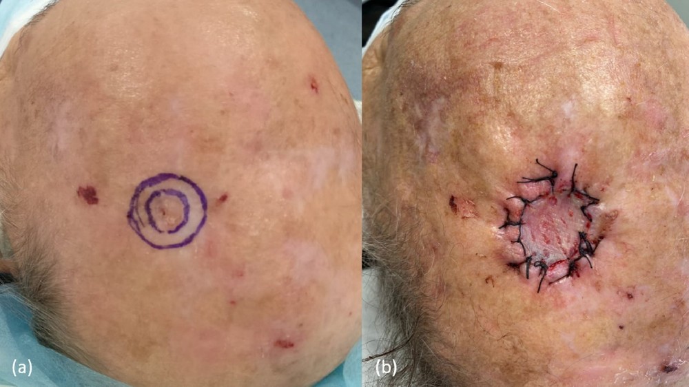 鱗狀細胞皮膚癌 Squamous Cell Carcinoma