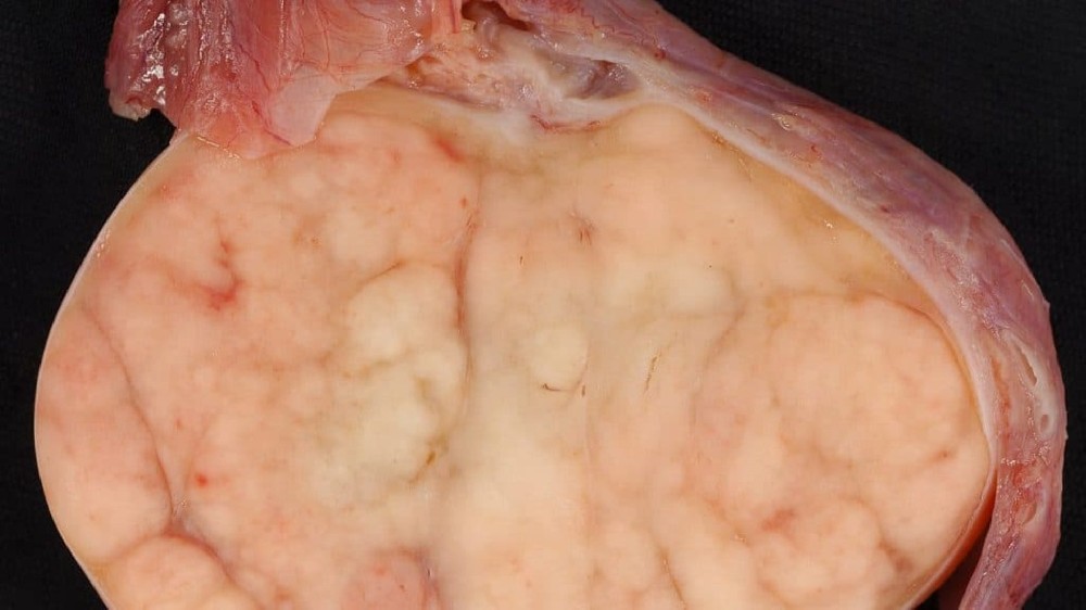 睪丸癌 睪丸生殖細胞瘤