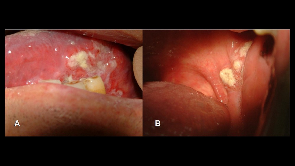 扁桃腺癌 扁桃腺腫瘤