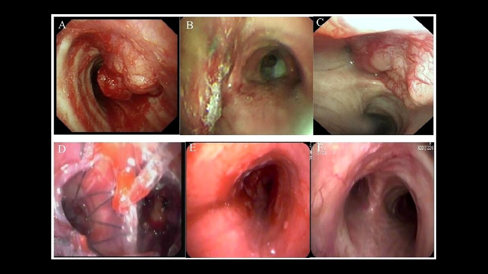 氣管癌(氣管支氣管腫瘤) 1 氣管癌(氣管支氣管腫瘤)