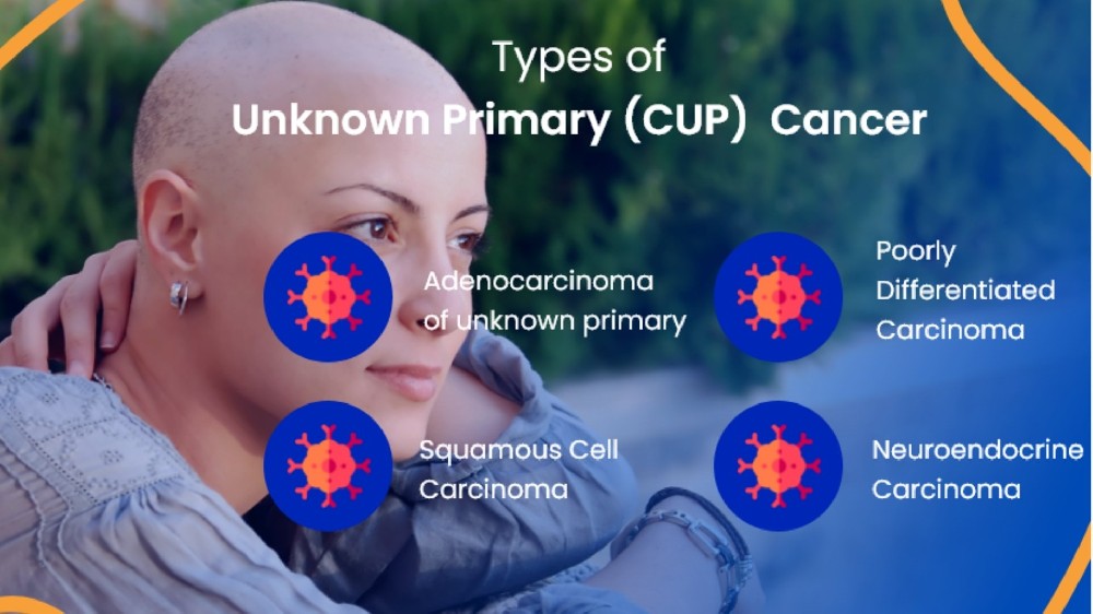 未知原發性癌症 (Carcinoma Of Unknown Primary)