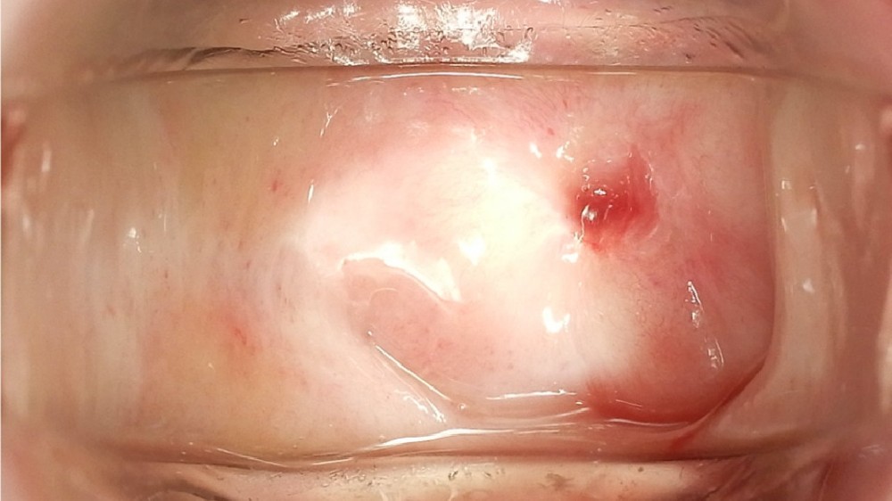 尿道癌 (Urethral Carcinoma)