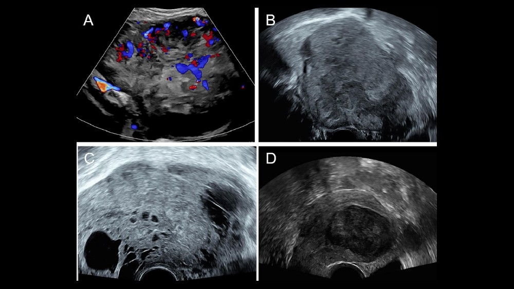 子宮肉瘤(子宮纖維肉瘤)1 子宮肉瘤(子宮纖維肉瘤)