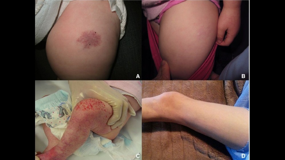 血管腫瘤（血管肉瘤）